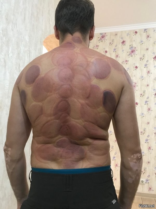 Недавно делали мне такую процедуру, правда не совсем по правилам, описанным в статье - но самочувствие улучшилось! :)