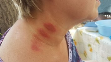 Укусила меня такая гадина во сне. Заживало долго.