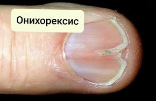 И молотком получал. И дверцей автомобиля ущемлял. И у других неоднократно видел. Но подногтевая гематома выглядит иначе. Да и ассоциативный ряд странноватый: эндокардит, псориаз, разбитые сосуды...
Тут тонкая продольная полоска. Иглу под ноготь загоняли? Тогда не разбитые, а проколотые сосуды. Что тоже звучит "по-дебильному"(с). 
Больше похоже на один из видов ониходистрофии.