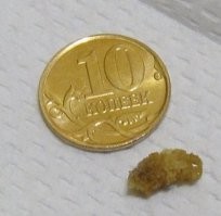 Камень в почках под микроскопом