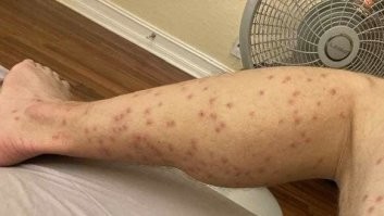 Интересно, куда этот дебил в поход ходил, что его так клопы покусали, в гости к бомжам на теплотрассу?