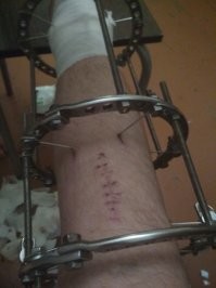 Гипс неподвижно фиксирует мягкие ткани. Срастется ли кость под ним и правильно ли срастется - это как повезет.
Если хочешь точности и надежности - ввинчивай штыри прямо в кость!