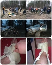 Хм... Я в 2012 году, ногу сломал. 
 
Мне железки в ногу вставили и пластиковый гипс "намотали". 
Лёгкий, мыть можно. 

Я даже за рулём с ним ездил. 
МКПП, если что. ;)
