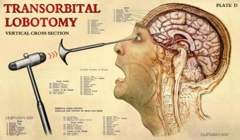 Лоботомию раньше считали панацеей от многих болезней