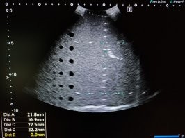 Пример с ультразвуком.
Меня не спрашивайте - я нихрена не понимаю как они сравнивают дырки.