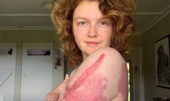 Келси Вагхорн любовалась вулканом в Новой Зеландии, очередной выброс газа и пепла... В итоге она получила ожоги 45% поверхности тела, провела в больнице 65 дней, в том числе 10 из них   в реанимации, из них неделю в медикаментозной коме.
Келси перенесла 14 операций. Врачи пересадили ей кожу на руках, ногах и пояснице. Ей сделали 28 переливаний крови и компонентов крови   20 переливаний эритроцитов и восемь  переливаний плазмы. Ей пересадили 464 квадратных сантиметра кожи от доноров. Ей пришлось заново учиться ходить...
---
При этом можно сказать что Келси повезло, т.к. почти все остальные участники ее группы погибли отравившись сернистыми газами или сгорев заживо...