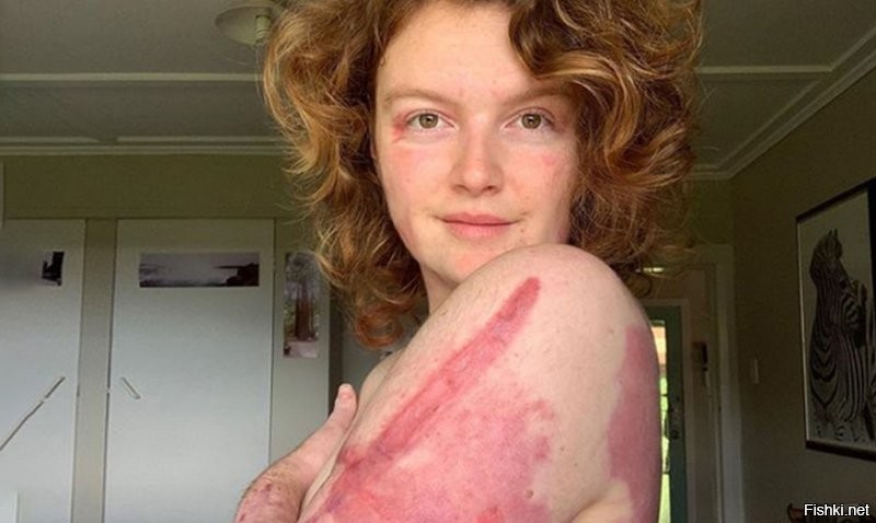 Келси Вагхорн любовалась вулканом в Новой Зеландии, очередной выброс газа и пепла... В итоге она получила ожоги 45% поверхности тела, провела в больнице 65 дней, в том числе 10 из них   в реанимации, из них неделю в медикаментозной коме.
Келси перенесла 14 операций. Врачи пересадили ей кожу на руках, ногах и пояснице. Ей сделали 28 переливаний крови и компонентов крови   20 переливаний эритроцитов и восемь  переливаний плазмы. Ей пересадили 464 квадратных сантиметра кожи от доноров. Ей пришлось заново учиться ходить...
---
При этом можно сказать что Келси повезло, т.к. почти все остальные участники ее группы погибли отравившись сернистыми газами или сгорев заживо...