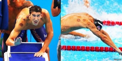 "Клиппенштейн заявил, что ничего кроме кровоподтёков и гематом банки не делают."    А может и делают...