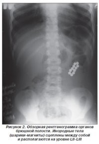 Ну а где клинический рентген? Выглядит прикольно. Полбеды, есл съеден пучек сразу - он так куском и выходит часто. А вот трагедия начинается, если глотают по штучке-две.. И они слипаются через петли кишечника. Вот тут только операция и если не успели, то свищ-перитонит-смерть с высокой вероятностью... Ну их нафих ...
