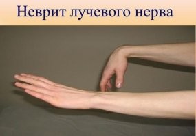 А я как то себе подобную фигню на резинках сделал, но с другой стороны, для разгибания, когда в результате травмы пострадал лучевой нерв. Пару месяцев ходил со "свисающей кистью", пока нейроны заново не проросли внутри нервного канала лучевого (1,5 - 2 мм в сутки, заново от спинного мозга или от места повреждения, я точно не знаю, как они восстанавливаются, была полная обездвиженность разгибателей, восстановилось полностью, при этом СГИБАТЕЛИ работали нормально).