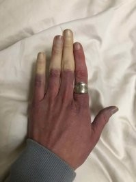 синдром Рейно. мерзкая, я вам скажу, штука. очень часто развивается сухая гангрена ногтевых фаланг