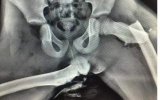 Шок-рентген: что бывает при аварии с теми, кто любит забрасывать ноги на панель.