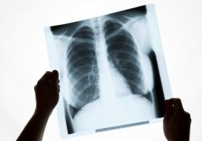 Вы когда нибудь видели флюорографию?
Эта говнокартинка двоечника ни как не похоже на настоящий снимок.
Вот, к примеру