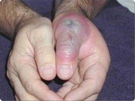 Это укус не "Черной вдовы", а "Коричневого крестовика" или "Коричневого паука-отшельника"(Loxosceles reclusa). Показана средняя стадия, 3-4 день после укуса. Через неделю после укуса, от пальца мало что останется.