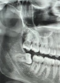 я 12 числа выдернул свой последний зуб мудрости , в 41 год он начал пробиваться через десну (че ему и дальше не сиделось на месте) я год терпел пока не понял что он под наклоном растет собака теперь мне 6 зубов лечить-ремонтировать изза него .