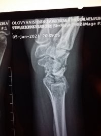 Сломал руку. Надеюсь на "Фишки познавательные"