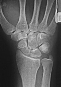 Перелом ладьевидной кости.