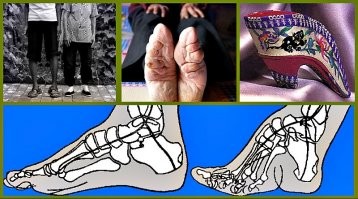 Бинтова ние ног   обычай, практиковавшийся в Китае (особенно в аристократической среде) с начала X до начала XX века.

Полоской материи девочкам привязывали к ступне все пальцы ноги, кроме большого, и заставляли ходить в обуви малого размера, отчего ступни значительно деформировались, иногда лишая возможности ходить в будущем. Такие ноги традиционно назывались «золотыми лотосами». От размера ступни зависел престиж невесты, к тому же считалось, что принадлежащей к высокому обществу даме не следует ходить самостоятельно. Это бессилие, неспособность к передвижению без посторонней помощи составляло, по литературным свидетельствам, одну из привлекательных черт женщины-аристократки: здоровые и недеформированные ноги ассоциировались с крестьянским трудом и «подлым происхождением».