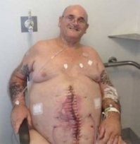 Он же после удаления "аппендицита"