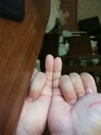 Не считаю это за дефект, но что есть то есть, лет 15 наверно назад, заметил что фаланга мизинца левой руки, длиннее фаланги мизинца правой руки.... В быту, это ни как не отражается, вспоминаю про это, наверно раз в 2-3 года...