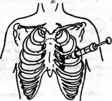Раньше адреналин вообще вводили внутрисердечно. Такой длинной-длинной иглой.