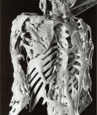 Фибродисплазия