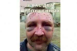 Как избавиться от синяка за 3 дня