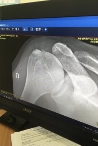 В том году передо мной нарисовалась тетенька на маленькой красной машинке. Я ехал по главной, она выезжала из двора. Закончилось это перелетом моей тушки через эту самую машинку, велосипед не пострадал, я на первый взгляд тоже. Тетеньку обложил трехэтажным матом и отпустил восвояси. А утром уже не смог встать с постели, в двух ребрах трещины, от плечевой кости вообще кусок отвалился. Почти два месяца на больничном. Плечо до сих пор побаливает. Крч теперь и я узнал что мог 0.7-лям получить)