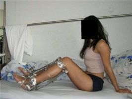 Полоской материи девочкам привязывали к ступне все пальцы ноги, кроме большого, и заставляли ходить в обуви малого размера, отчего ступни значительно деформировались, иногда лишая возможности ходить в будущем. Такие ноги традиционно назывались «золотыми лотосами». От размера ступни зависел престиж невесты, к тому же считалось, что принадлежащей к высокому обществу даме не следует ходить самостоятельно. Это бессилие, неспособность к передвижению без посторонней помощи составляло, по литературным свидетельствам, одну из привлекательных черт женщины-аристократки: здоровые и недеформированные ноги ассоциировались с крестьянским трудом и «подлым происхождением».

А ноги удлиняют аппаратом Илизарова (может уже и другие методы есть, не слежу за этим). Принцип такой: пилятся (или ломаются, не знаю как уж правильно) кости, ставится аппарат Илизарова, штифты вкручиваются в кости и понемногу растягиваются. На месте перелома нарастает хрящевая ткань, которая становится впоследствии костной. И так милиметр за милиметром, сантиметр за сантиметром. Жене в детстве по медицинским показаниям ставили аппарат Илизарова, жила с ним больше полугода. Говорит, что больно. И восстанавливаешься потом долго, т.к. надо мышцы тренировать, которые столько времени без должной нагрузки были.

Может что-то не совсем корректно описал, т.к. не специалист в этой области, но принцип примерно такой. Прошу тапками не закидывать,тежели где-то неточно описал.