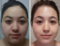 и стало видно, что нос был ранее сломан