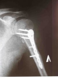 Моё левое плечо