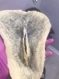 Мужчина пожаловался врачам на чёрный и "волосатый" язык