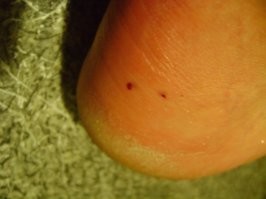 Укус 10-12 -ти сантиметровой сколопендры. Лично ощутил... Ну его на х@й... Пару дней нога на полтора размера больше была...