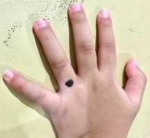 Дебилы!!! Бегом к онкологу!!! Это, по ходу, меланома! А, может, уже и поздно.