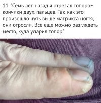 Гы... Вот теперь понятно. 
 В ещё советское время у нас мужик лишился стопы. Дали 3 группу, рабочую, с обязательным ежегодным медосмотром. Вдруг отрастёт...
