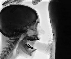 Бля, больше не буду глаза протирать! А где мой любимый рентгеновский снимок, а, вот он.