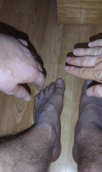 Я тож витилижный. На попе тоже но не буду показывать ))