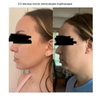 15 людей, которые решились на пластику - и ни секунды не пожалели