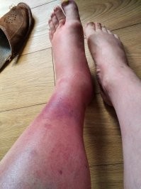 Климат меняется, а с ним и насекомые приходят разные. У нас в Литве умудрились завезти мошкУ. Ту самую, сибирскую. Так эта падла прижилась. Не в таких количествах, но есть. Товарищ на прошлой неделе на больничный ушёл, траву возле дома косил триммером. Укусила. Прислал фото. Слабые смехи. Кормят антибиотиками.