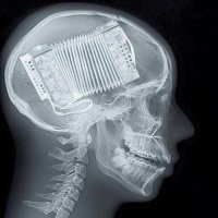 В Ирландии врачи извлекли из тела женщины более 50 батареек