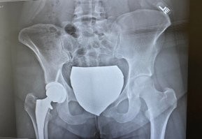 Судя по силуэту жировых отложений, это очень жирная бабища. Если ей 24 то скорей всего, она редко пользовалась ногами. Так что особо ничего не изменится в ее жизни.