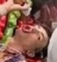 Ну так вот он, геморроидальный анус: