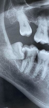У меня такое было. Причём определили не сразу. Пришёл к стоматологу - зуб болит. Та смотрит, говорит зуб здоров. Вероятно воспаление тройничного нерва. Сделали рентген, но не захватили область с зубом мудрости. А ещё майские праздники были... Короче ещё два дня я на стены лез так больно было. Приехал в другую клинику, там причину сразу нашли, но сказали, что удалять этот зуб мудрости можно только в стационаре и под общим наркозом. Там какие-то сложности были. Но в стационар только после того как пройдёт воспаление... Короче ещё пару дней мук и он всё таки вытолкал здоровый зуб. Просто выпал и всё. Так и не собрался его удалить. Вырос и "заменил" выпавший зуб.