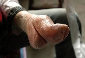 Можно было бы и фото выложить, во что ноги превращались после этого... Хотя зрелище не для слабонервных.