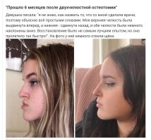 Нестыковка фото и описания. На фото до врачей: верхняя челюсть - назад; нижняя - вперёд.