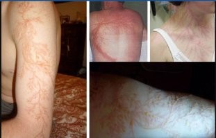 А когда попадает в человека - она создаёт причудливые изображения, известные как "фигуры Лихтенберга".