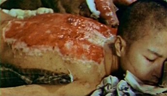 Парню 16 лет. Сумитэру Танигути. Пострадал при Хиросиме. Умер в 88 лет.
Так чем ядерный ожог страшнее обычного? Ничем.