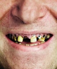 Автор так же далёк от темы на которую пишет, как Волочкова от особенностей труда такелажников заполярья. Видимо в жизни не приходилось это видеть воочию. Это конечно слава богу, ибо зрелище так себе. У Деппа просто налёт. Появляется от частого курения, от злоупотребления кофе/чая, от неправильного питания, ну и, естественно, от пренебрежения элементарной гигиеной. Это явление довольно распространено. Особенно раньше. Когда курили махорку и во множестве употребляли жевательный табак. А современных средств гигиены и профилактики не было и в помине. То что он говорит, что у него кариес, очень может быть, но гнилых зубов на фото не видно. Кариес бывает разный. У человека может быть запущеный пульпит, но снаружи зуб выглядит вполне здоровым. Удалят ему зубной камень, отбелят зубы и будет Апполон. Процедура не сложная и не разорительная. В СШП не знаю. Не бывал.