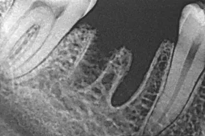 Извиняюсь, я много раз за свою жизнь сталкивался со стоматологами, но мне ни разу не удаляли зуб при помощи бура. И распиливали, и десну резали, и выдалбливали зубилом (когда недоудалённый кусок корня пошёл в гайморовую пазуху), но никогда не использовали бур. Что-то тут не то. Да и по рентгену видно, что зуб удалён давно (гораздо дольше двух недель, следов от корней совсем не видно).