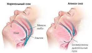 Апноэ во сне :
 Разновидность апноэ, для которого характерно прекращение лёгочной вентиляции во время сна более чем на 10 секунд. 
Чаще оно длится 20 30 секунд, хотя в тяжёлых случаях может достигать 2 3 минут и занимать до 60 % общего времени ночного сна. 
При регулярных апноэ (обычно не менее 10 15 в течение часа) возникает синдром апноэ во сне с нарушением структуры сна и дневной сонливостью, ухудшением памяти и интеллекта, жалобами на снижение работоспособности и постоянную усталость.